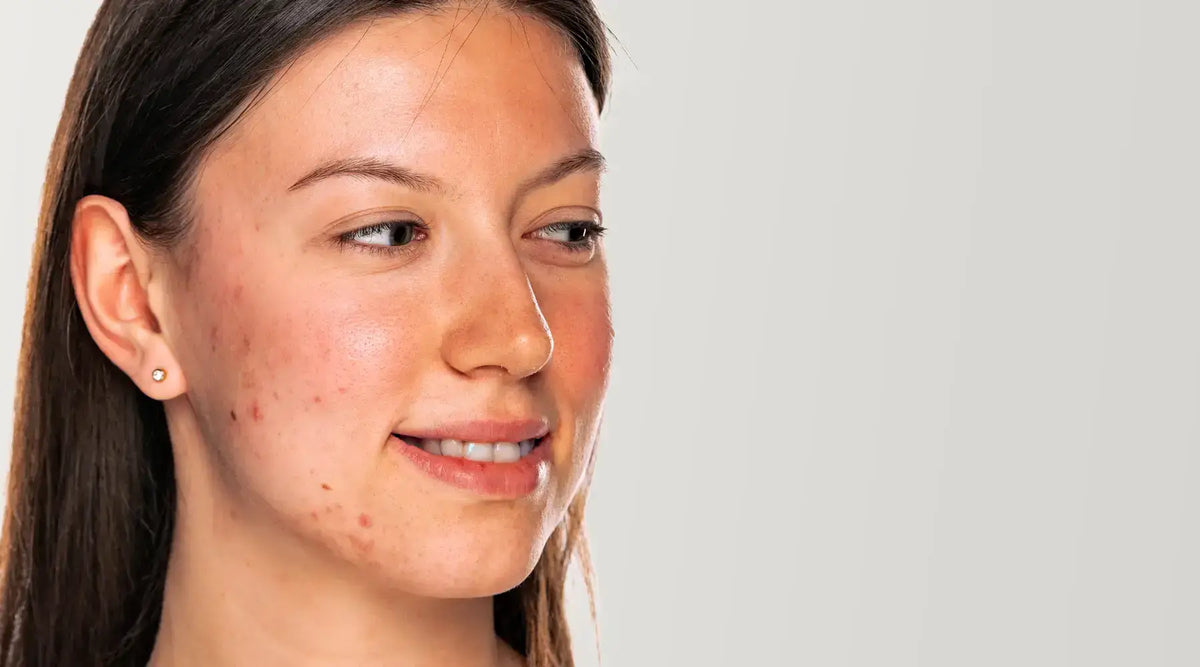 Find Your Perfect Pimple Patch: Target Breakouts Smarter