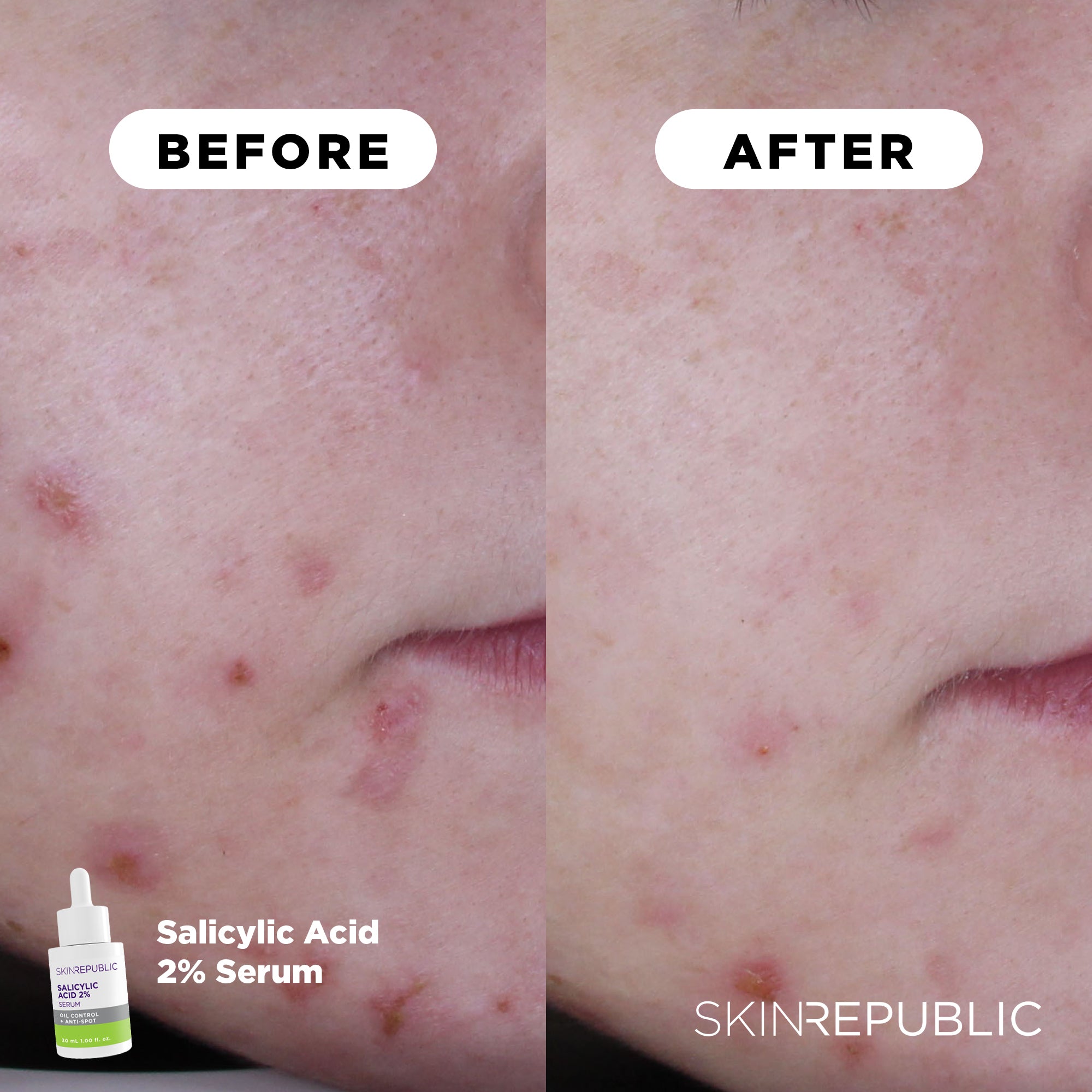 Salicylic Acid 2% Serum | Clears Pores + Pimples | Skin Republic