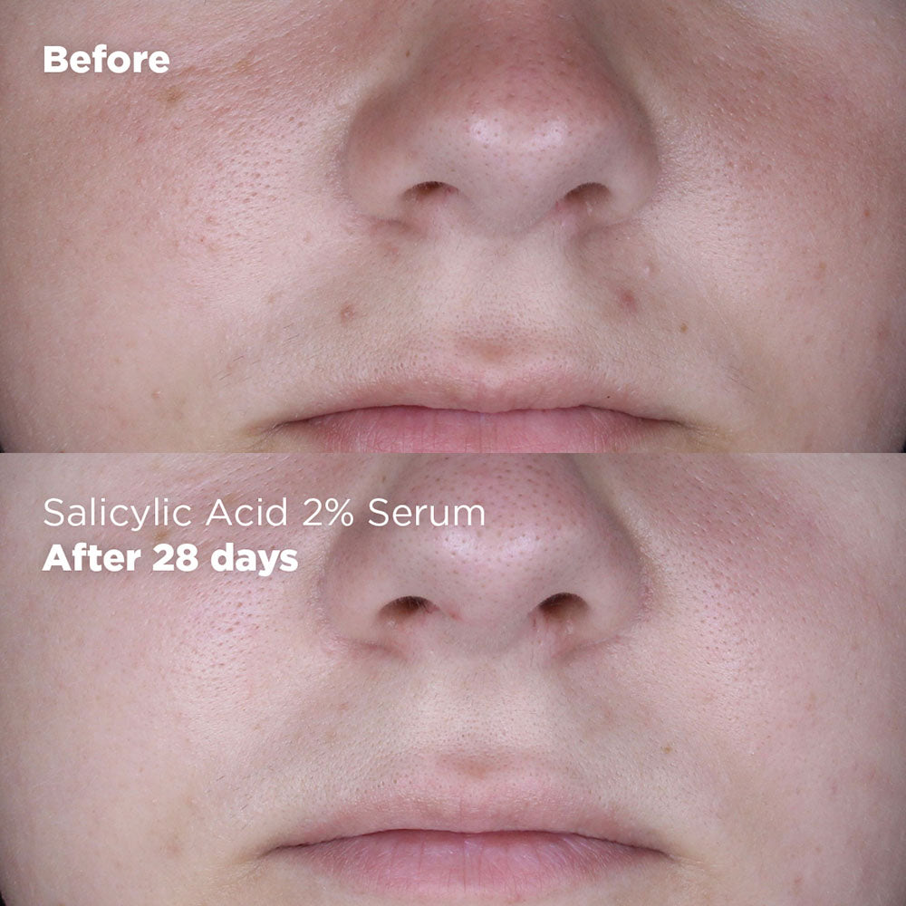 Salicylic Acid 2% Serum