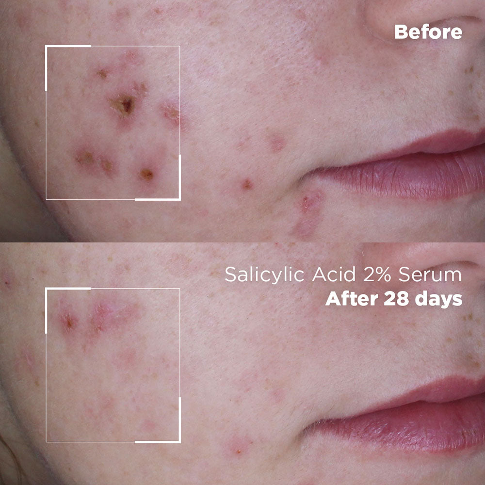 Salicylic Acid Before And After — free download